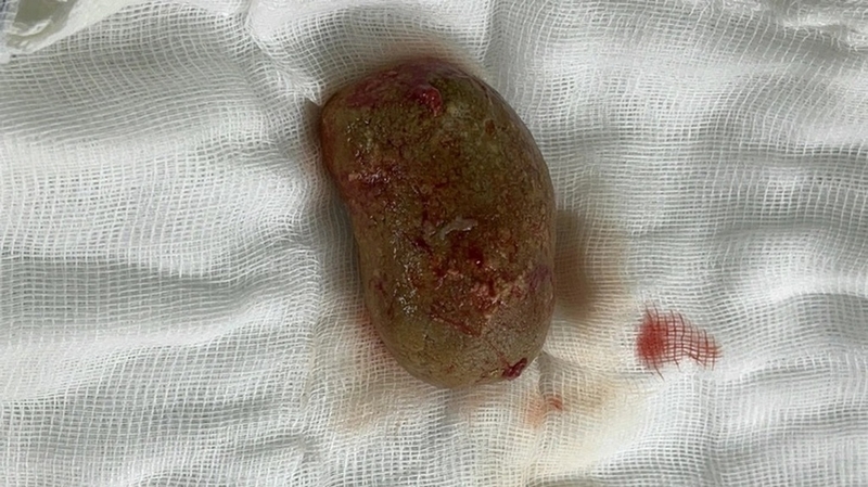 Sỏi tiết niệu - căn bệnh thường gặp của người Việt 3