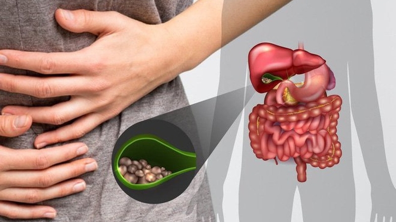Sỏi túi mật 13mm: Nguyên nhân, triệu chứng và cách điều trị 2