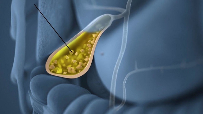 Sỏi túi mật và những điều bạn cần biết 2.jpg