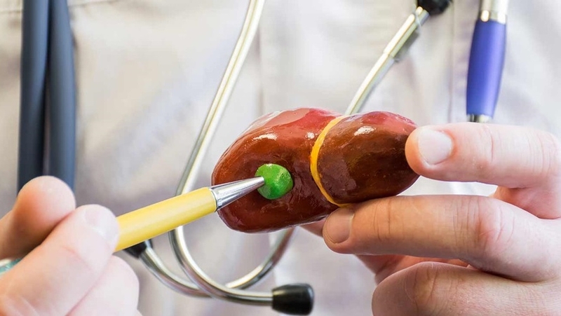 Sỏi túi mật khi nào cần phẫu thuật? 2