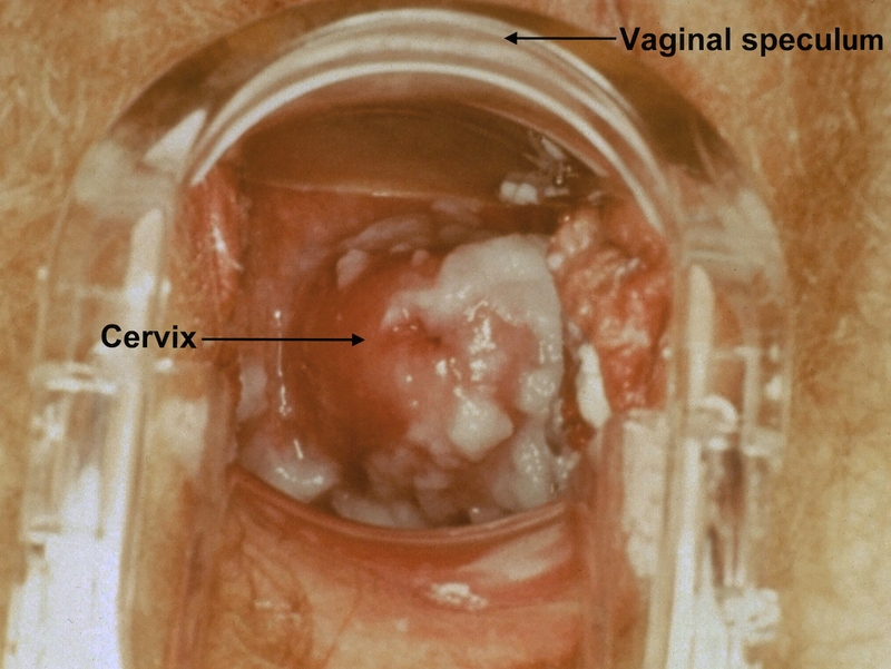 Tìm hiểu chi tiết về xét nghiệm soi tươi cổ tử cung 1