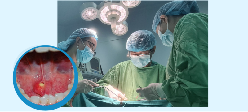 Sỏi tuyến nước bọt: Những thông tin quan trọng bạn cần biết 4