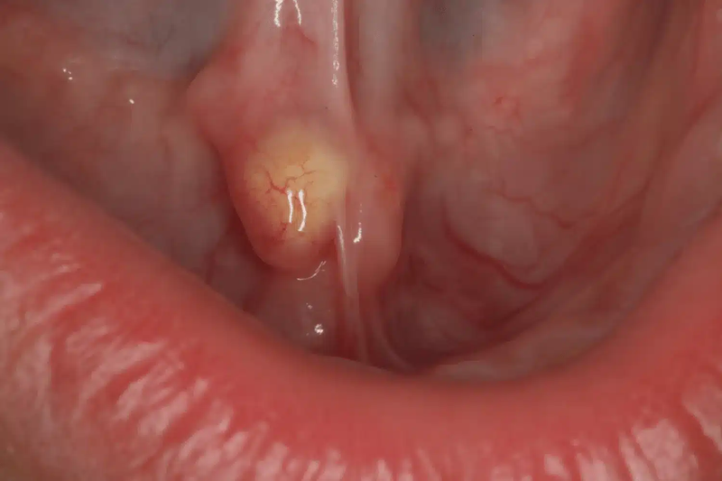 Sỏi tuyến nước bọt: Những thông tin quan trọng bạn cần biết 3