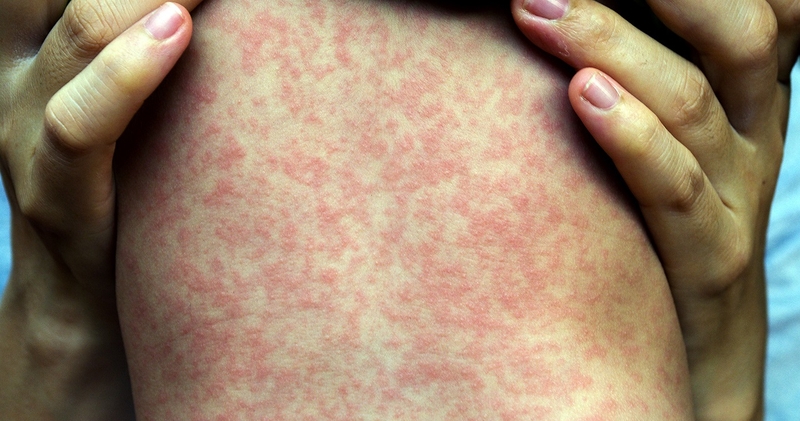 Sởi và rubella: Cách phân biệt và phòng ngừa hiệu quả 1