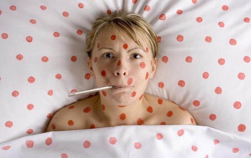 Những dấu hiệu khác nhau giữa sởi và sốt phát ban 3