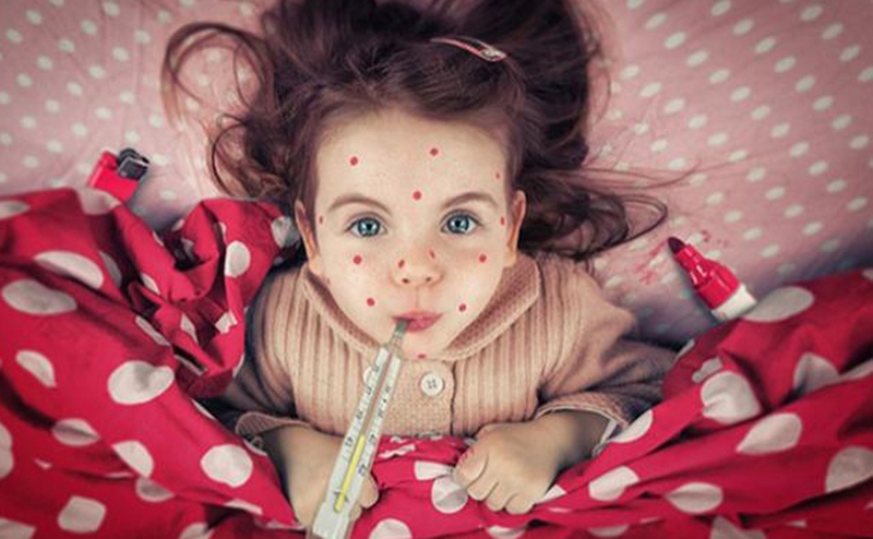 Cách phân biệt sởi và thủy đậu chính xác nhất 1