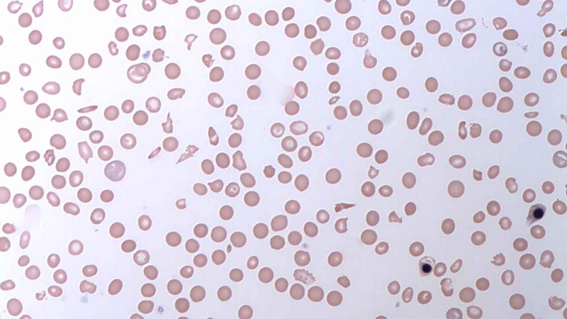 Thiếu máu tan máu kịch phát về đêm (PNH) là một bệnh hiếm gặp, trong đó hồng cầu bị phá hủy do hệ miễn dịch