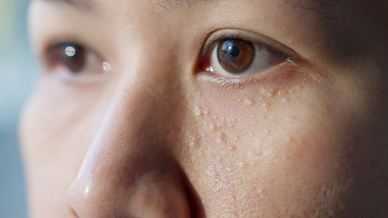 Việc dùng son dưỡng môi cho vùng thâm mắt có thể gây bít tắc và hình thành mụn kê