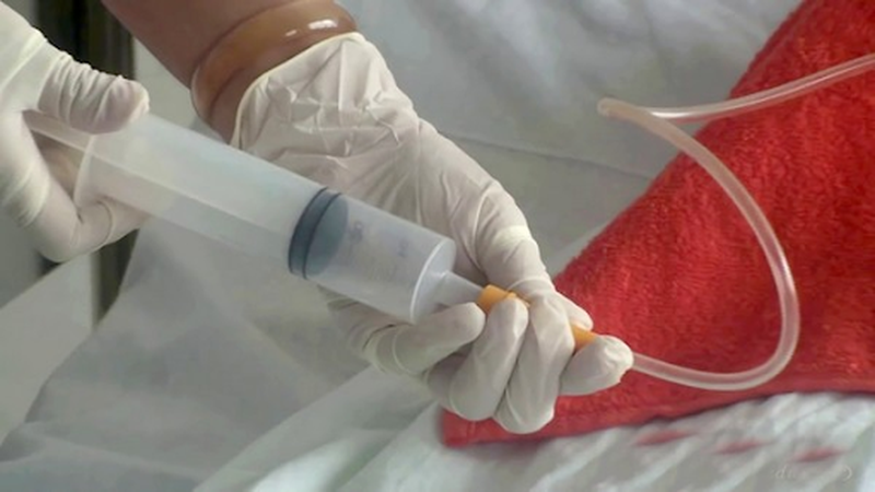 Sống chung với ống nuôi ăn3