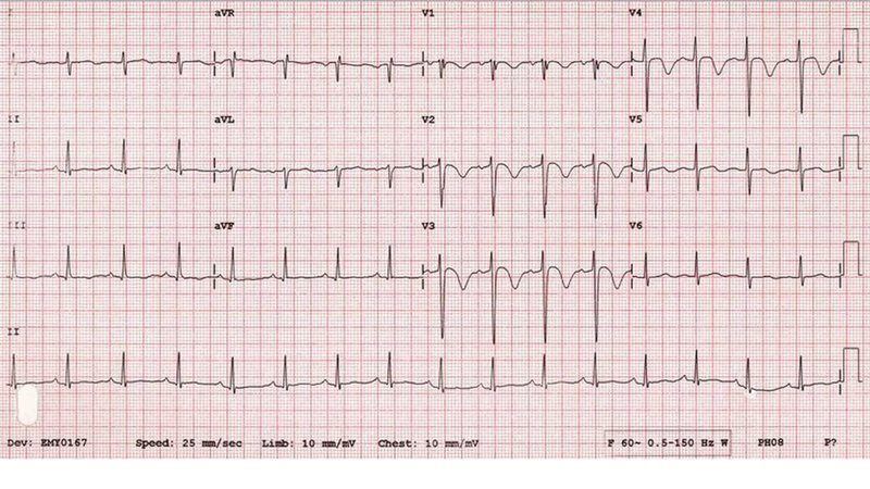 Sóng P là gì? Các dạng sóng P trong điện tâm đồ 1