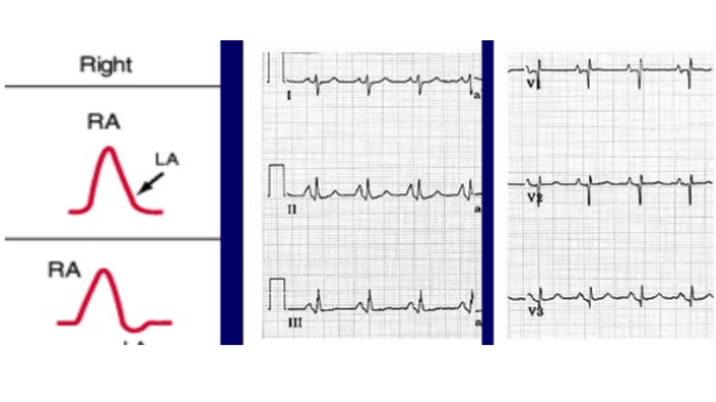 Sóng P là gì? Các dạng sóng P trong điện tâm đồ3