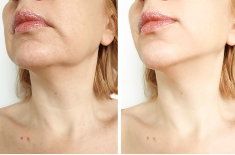 Sóng RF là gì? Sóng RF có tác dụng gì trong lĩnh vực làm đẹp 4