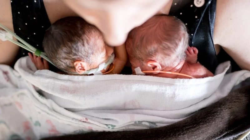 Song sinh dính liền có thể tách rời được không? 2