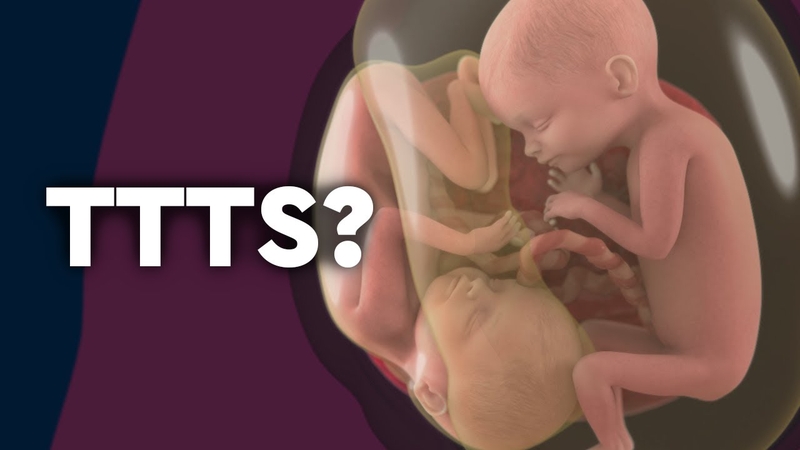 Hội chứng truyền máu song thai (TTTS) có thể gây nguy hiểm cho cả hai thai nhi