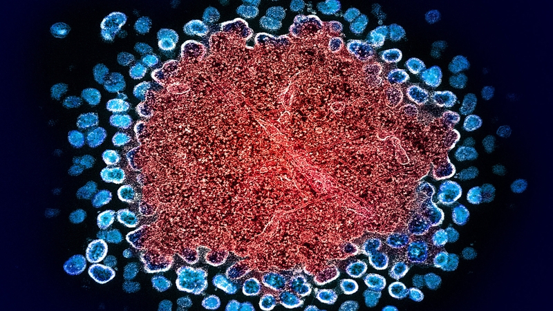 Sốt HIV kéo dài bao lâu? Những điều cần biết về sốt HIV 3