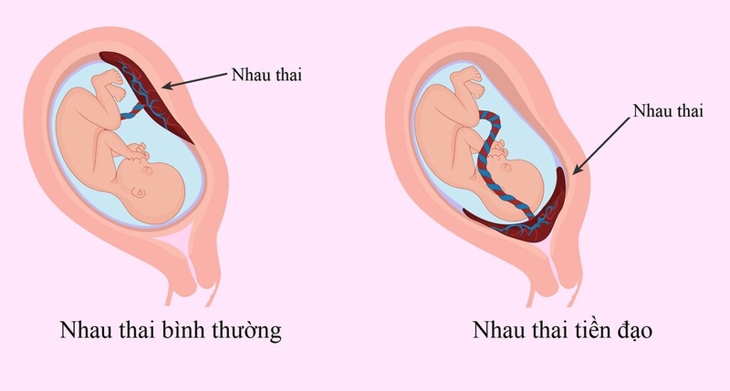Sót nhau sau sinh: Nguyên nhân, triệu chứng, điều trị và cách phòng ngừa 1