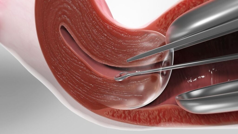 Sót nhau sau sinh: Nguyên nhân, triệu chứng, điều trị và cách phòng ngừa 3