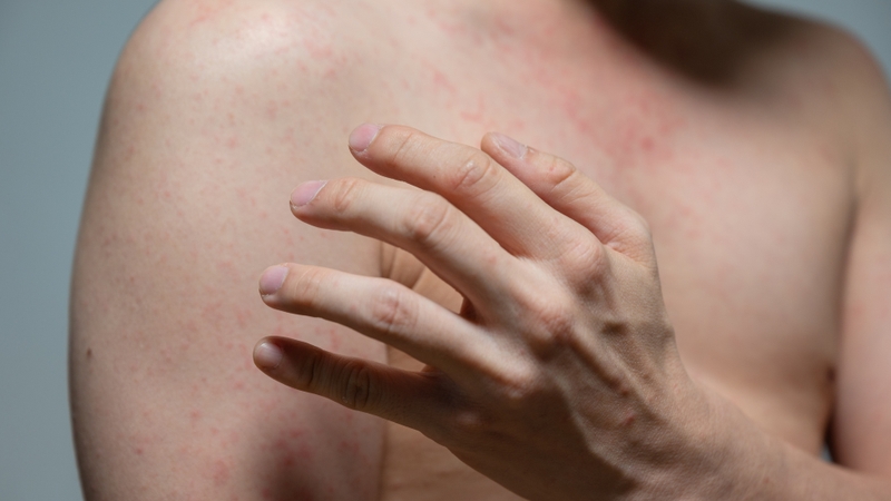 Sốt phát ban ở người lớn: Triệu chứng, nguyên nhân và cách điều trị hiệu quả 1