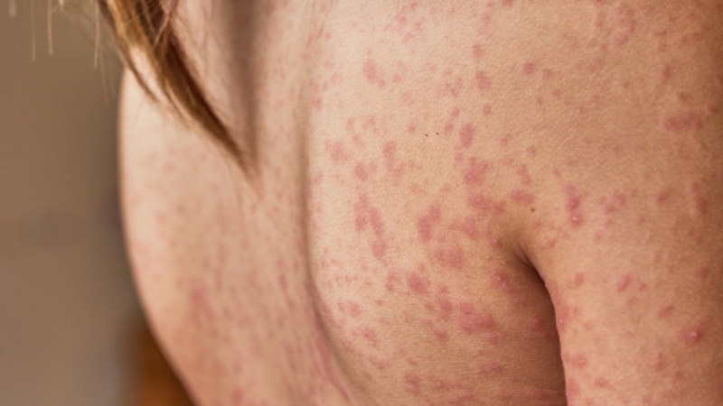 Sốt phát ban ở người lớn: Triệu chứng, nguyên nhân và cách điều trị hiệu quả 2