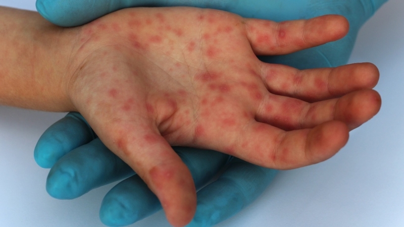 Sốt phát ban và sởi khác nhau như thế nào? Cách phân biệt 1