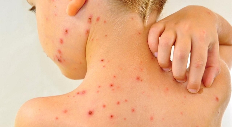 Phân biệt sốt phát ban và thủy đậu chưa bao giờ đơn giản đến thế 3