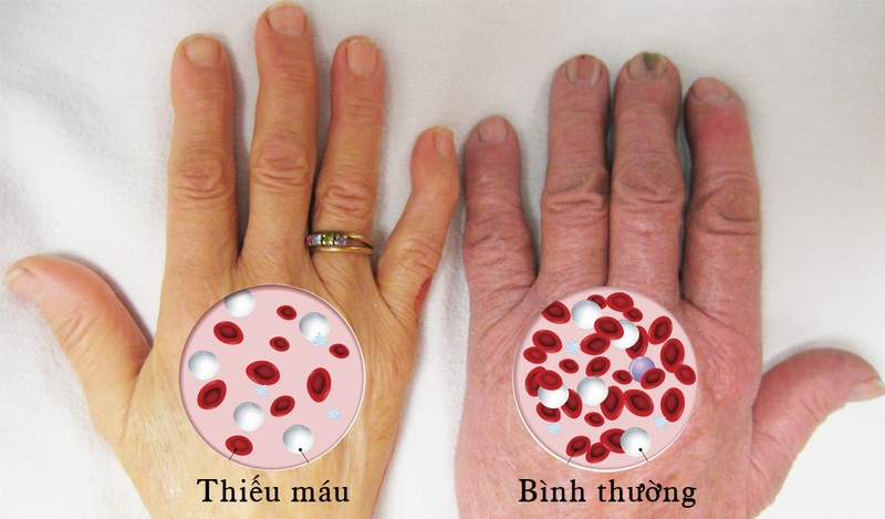 Sốt rét là gì? Sốt rét lây mạnh vào giai đoạn nào? 2