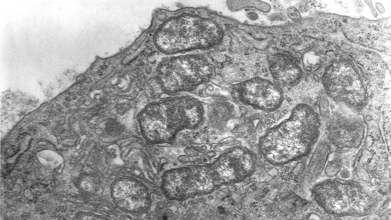 Sốt ve mò do vi khuẩn Orientia tsutsugamushi gây ra