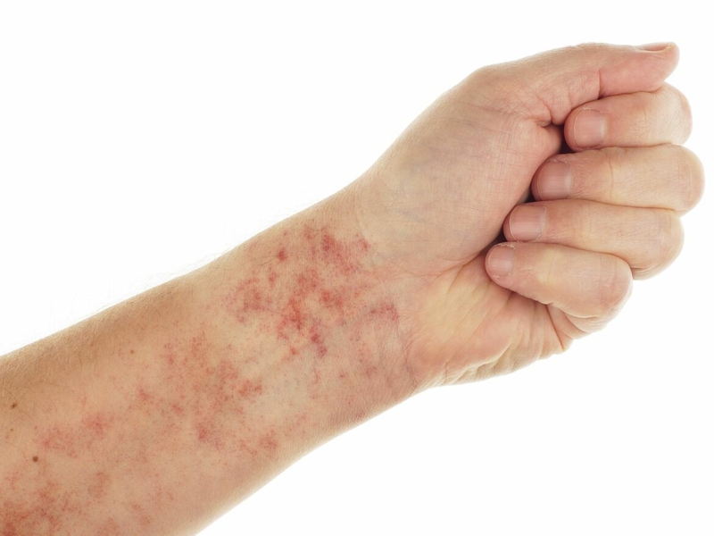 Sốt xuất huyết bị tiêu chảy có phải biến chứng nặng? 1