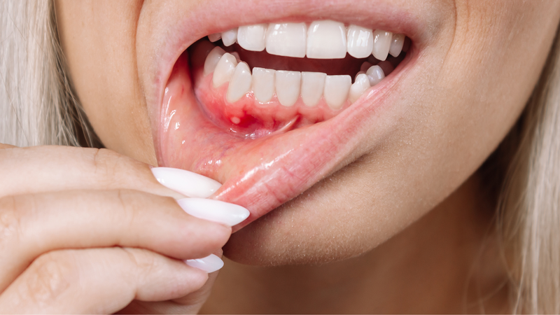 Sốt xuất huyết chảy máu chân răng có nguy hiểm không? 1