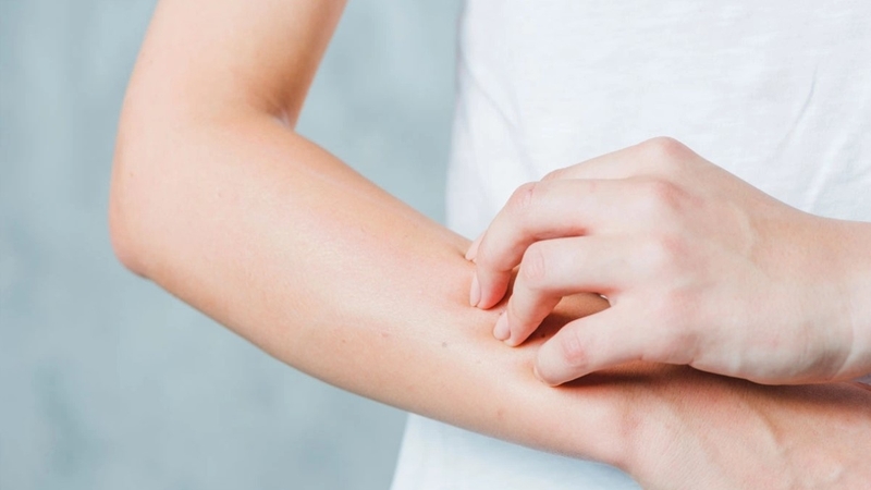 Sốt xuất huyết có ngứa không? Làm sao để khắc phục? 2