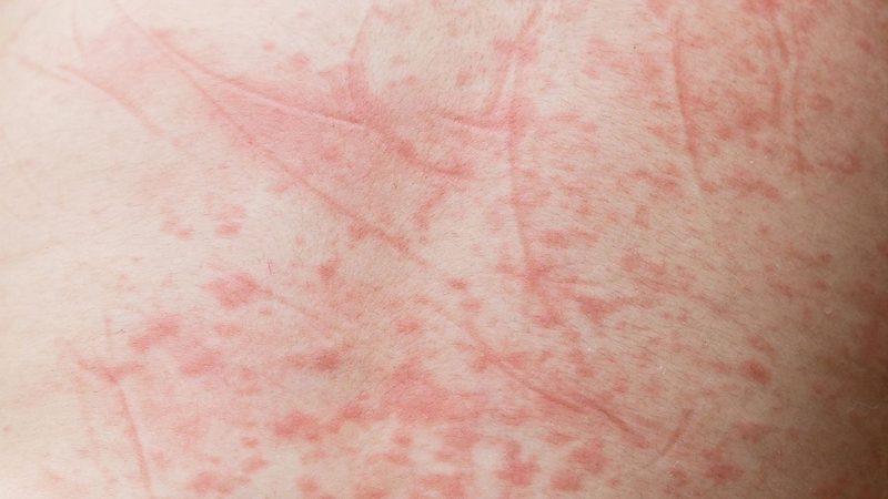 Sốt xuất huyết dưới da có nguy hiểm hay không? 2