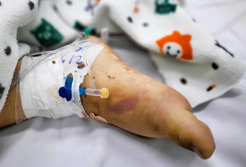 Sốt xuất huyết lần 2 có nặng hơn lần đầu không? 1