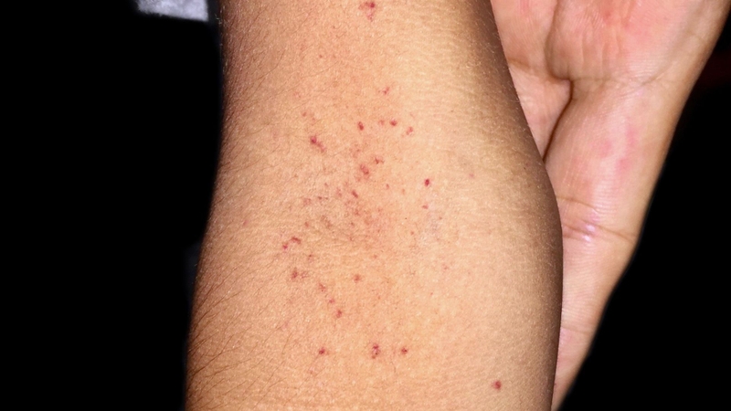 Sốt xuất huyết mấy ngày thì phát ban? 3