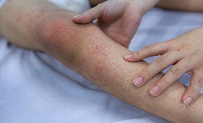 Một số trường hợp đến ngày thứ 9 vẫn cần theo dõi nguy cơ biến chứng