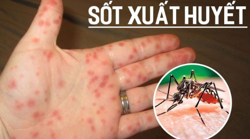 Sốt xuất huyết nổi mẩn đỏ có sao không? Làm sao xử lý? 1