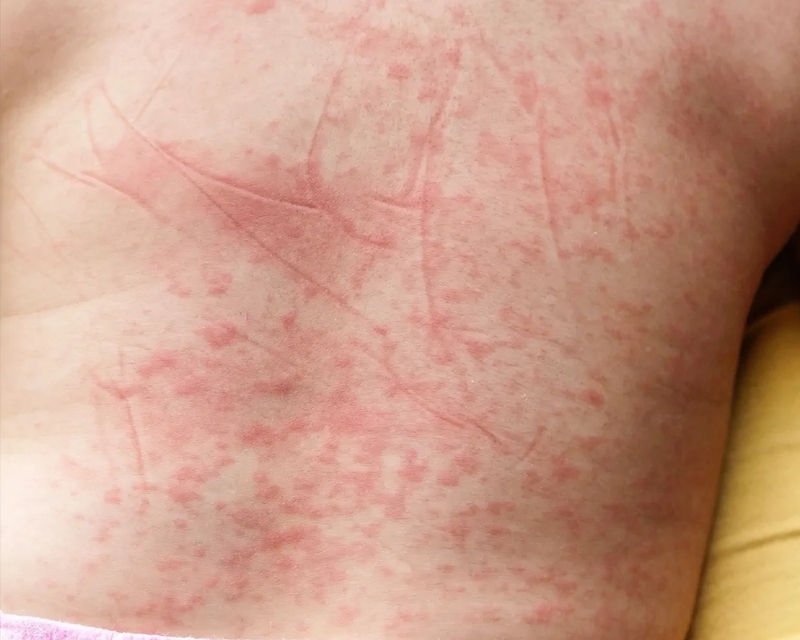 Sốt xuất huyết nổi mẩn đỏ là sắp khỏi phải không? 1