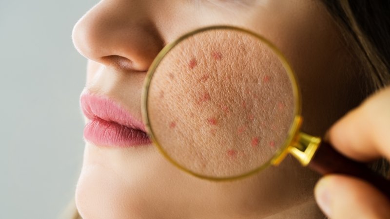 Người đang điều trị da liễu có thể nhạy cảm hơn với ánh nắng mặt trời