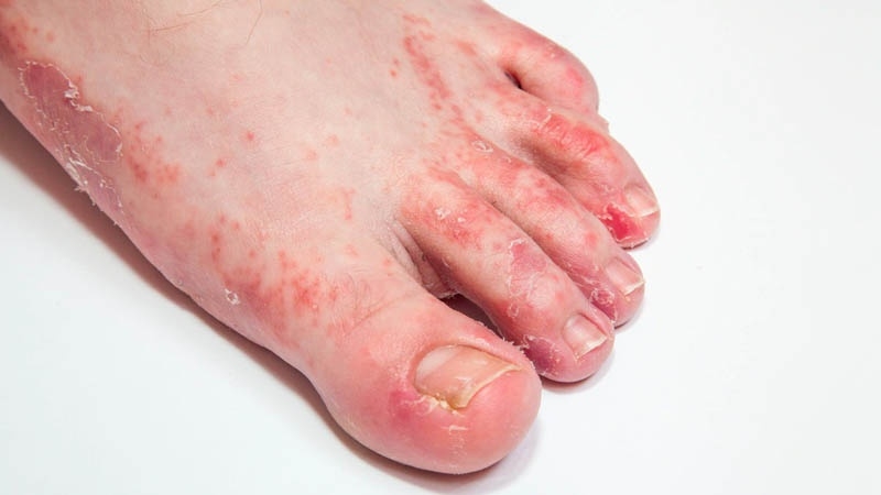 Spobet 100mg – Thuốc điều trị hiệu quả những bệnh lý về nấm ký sinh trên cơ thể 2