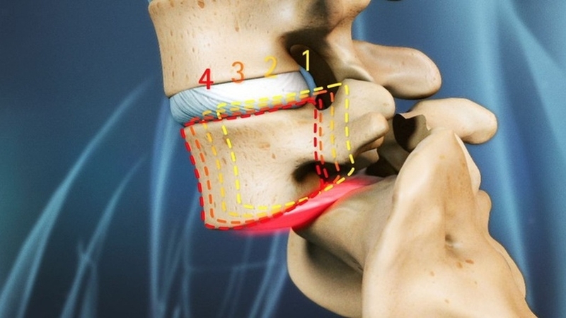 Spondylolisthesis là gì? Triệu chứng, chẩn đoán và cách điều trị 3