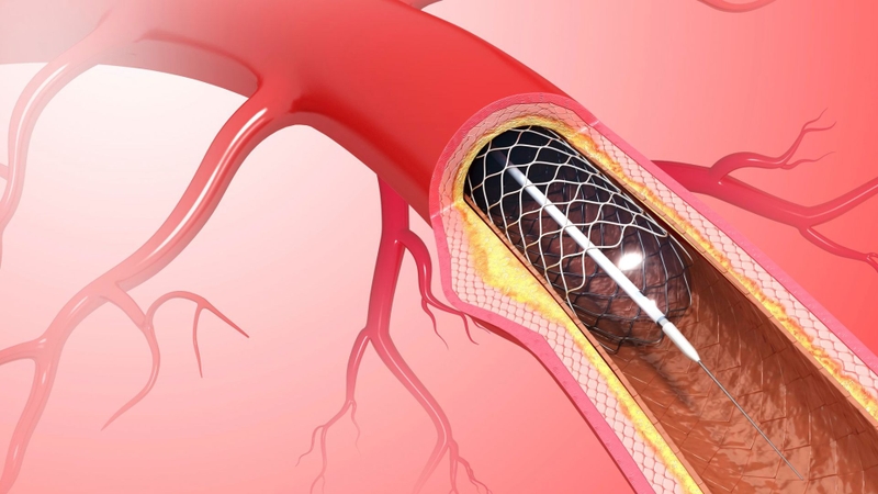 Stent là gì​? Một số loại stent được sử dụng phổ biến trong điều trị hiện nay 1