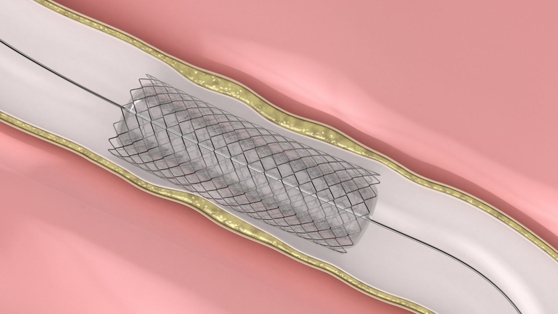 Stent là gì​? Một số loại stent được sử dụng phổ biến trong điều trị hiện nay 4
