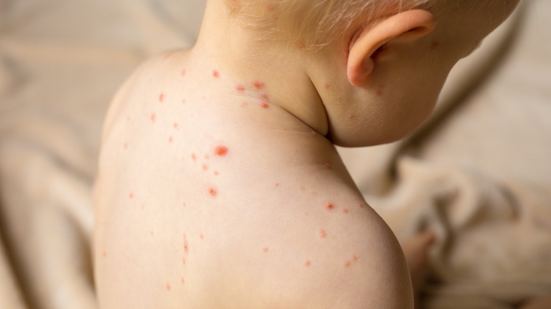 Su bạc bôi thủy đậu: Thành phần và công dụng tuyệt vời của thuốc 2