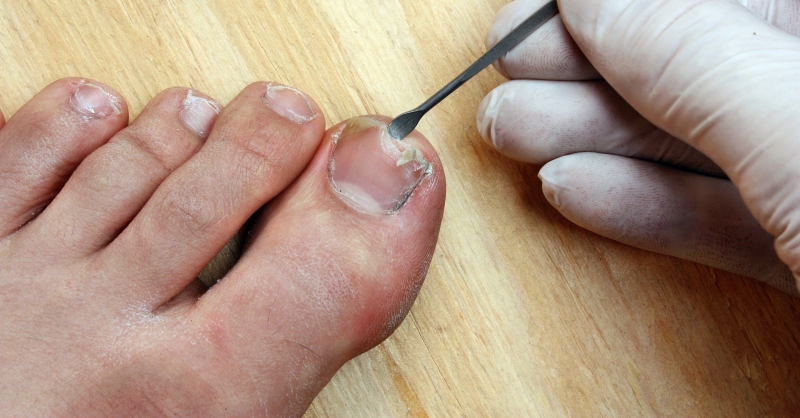 Sử dụng cây lấy khóe móng chân đúng cách 1