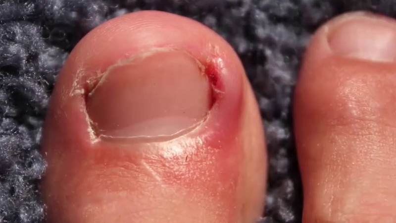 Sử dụng cây lấy khóe móng chân đúng cách 3