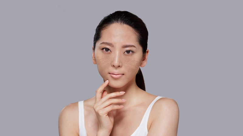 Sử dụng cấy que tránh thai có bị nám da không? 3