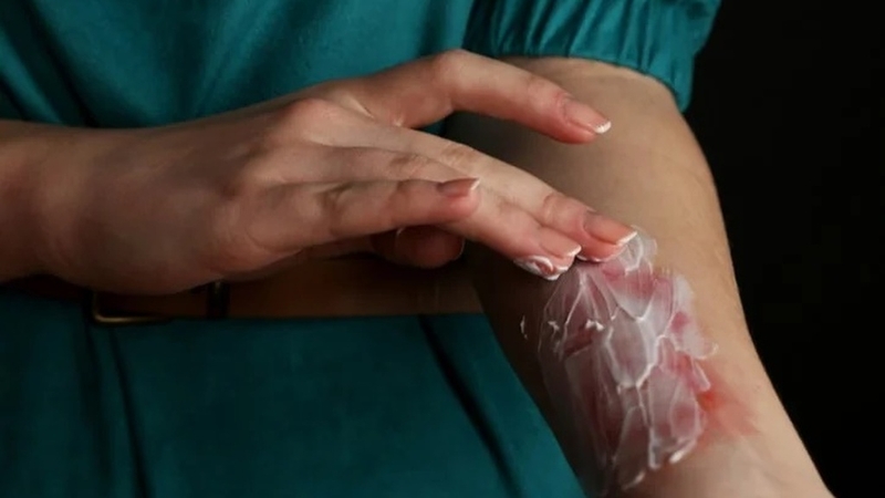 Sử dụng kem Hyalo4 Plus trị bỏng hiệu quả cần lưu ý gì? 2