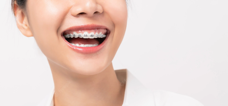 Sử dụng Mắc Cài Damon có tốt không?-3