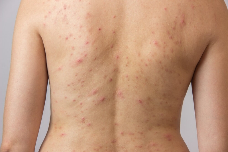 Sử dụng sữa tắm giảm mụn lưng Neo Acnes tinh chất tràm trà: An toàn và lành tính! 1