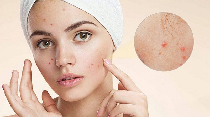 Uống vitamin C DHC có bị nổi mụn không? 2