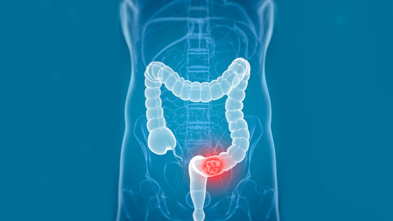 Sự gián đoạn của đồng hồ sinh học liên quan đến sự tiến triển nhanh chóng của ung thư trực tràng 2